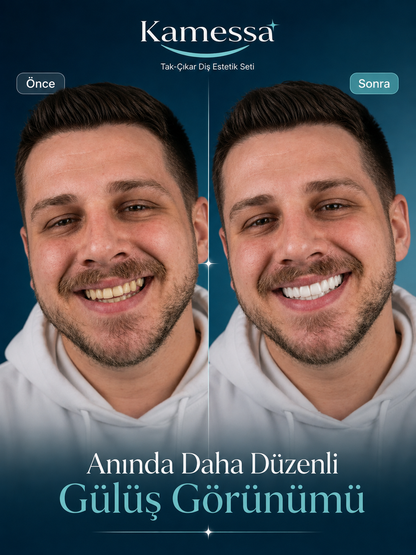 Kamessa™ SmileCover Tak-Çıkar Diş Estetik Seti – Alt & Üst Set